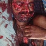 भालू के हमले से बिमलेश पाल जख्मी,हालत गंभीर 