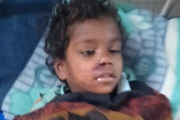 शौचालय की छत गिरने से 5 वर्षीय बच्ची गंभीर घायल, जिला अस्पताल रेफर