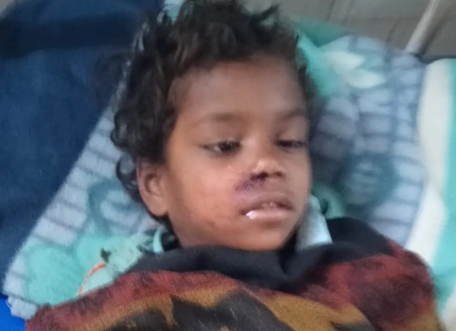 शौचालय की छत गिरने से 5 वर्षीय बच्ची गंभीर घायल, जिला अस्पताल रेफर